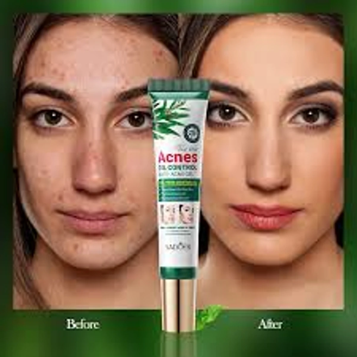 Anti-Acnes Gel